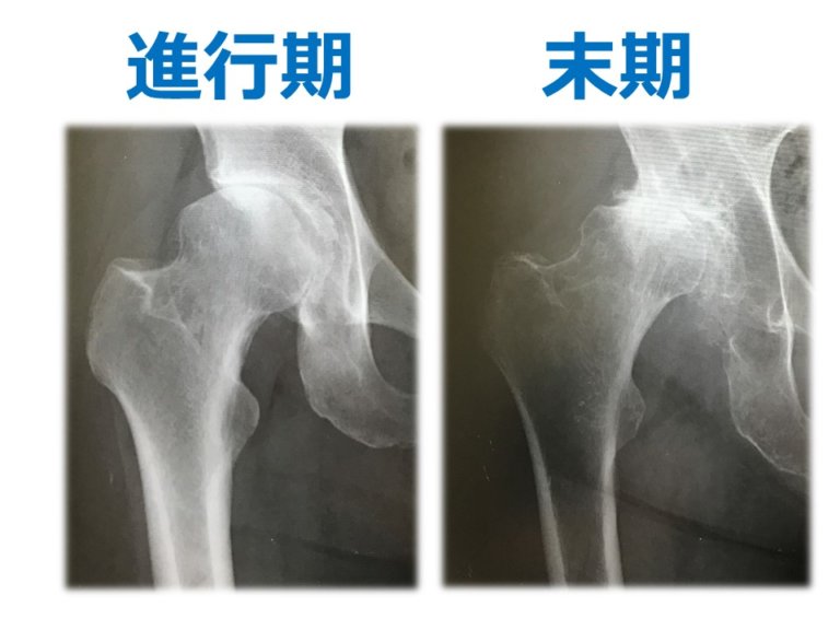 関節炎と変形性関節症の違いは何ですか?