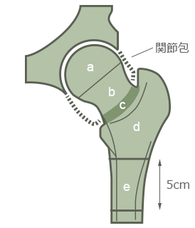 大腿骨近位部骨折の模型画像
