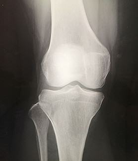 正常な膝関節レントゲン画像