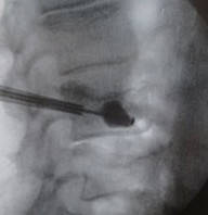 経皮的椎体形成術の手術資料画像