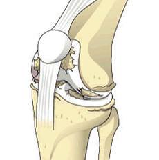 疾患のある膝関節の資料画像