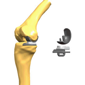 膝関節全体を人工関節に置き換えた場合の資料画像