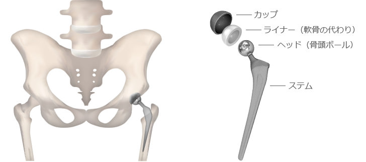 人工股関節挿入した解剖イラストと人工股関節のインプラント