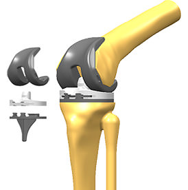 膝関節の一部を人工関節に置き換えた場合の資料画像