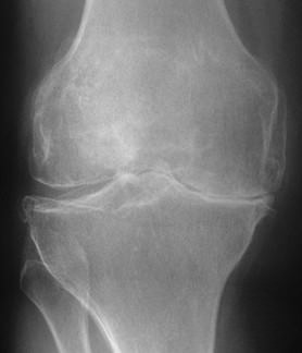 変形性膝関節症のレントゲン画像