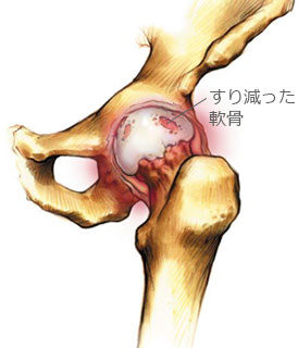 変形した股関節の解剖画像