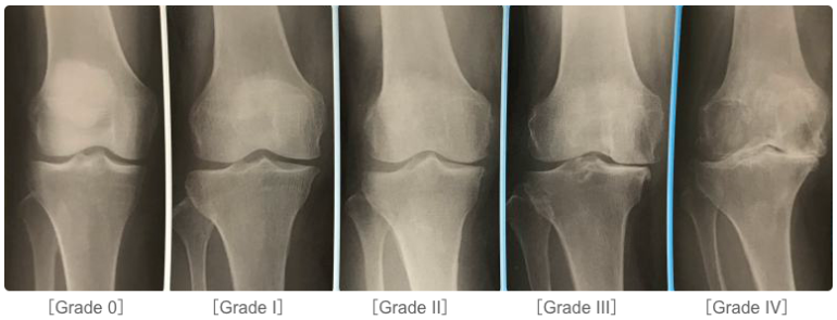変形性膝関節症の症状5段階資料画像
