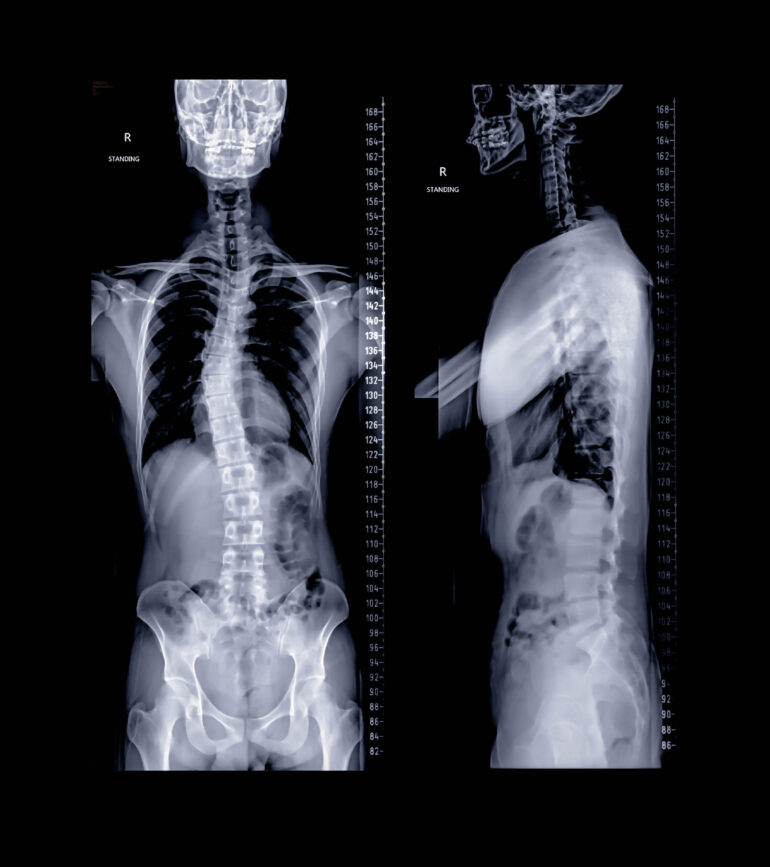 脊椎のレントゲン写真