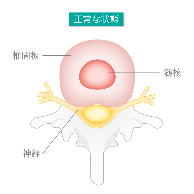 正常な椎間板（断面）