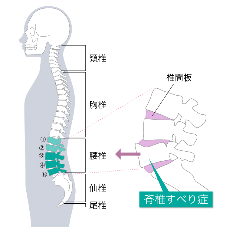 脊椎すべり症の説明図