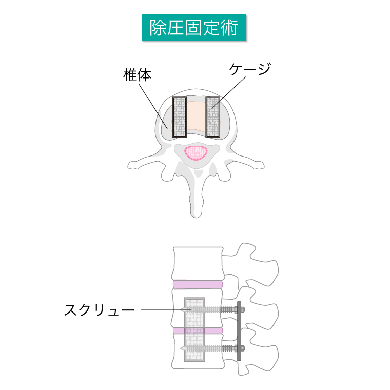 除圧固定術
